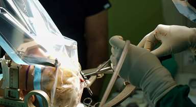 جراحی کاشت الکترود در مغز برای درمان صرع مقاوم به دارو