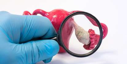 احتمال ارتباط نشانگرهای انعقادی با تشخیص و پیش آگهی سرطان تخمدان