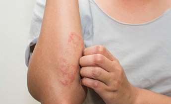 همه‌چیز درباره اگزمای سرشتی؛ از شیرخوارگی تا سالمندی