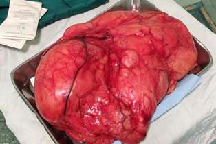 خارج کردن توده 8 کیلوگرمی از بدن یک بیمار