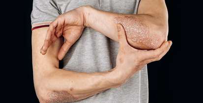 ابتلای بیش از 100 میلیون نفر در جهان به پسوریازیس 