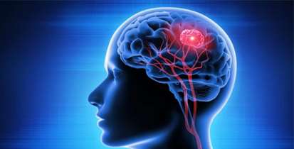 وبینار آموزشی «پزشکی دقیق و فرد محور در تومورهای مغزی» برگزار می شود