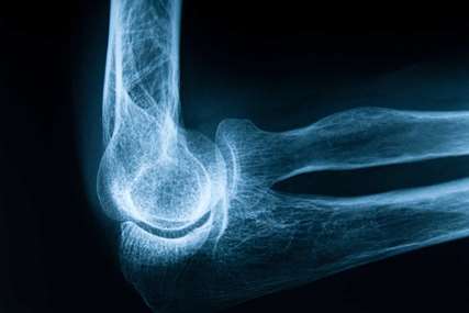 پیوند استخوان ران از یک جسد