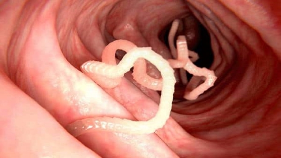 انگل‌هایی که رشد کودکان را مختل می‌کند